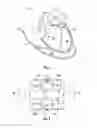 Fig. 04 - CARDIAC ASSISTANCE DEVICE