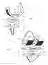Fig. 02 - Knee joint prosthesis and related method