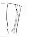 Fig. 06 - VESSEL REMODELING METHODS AND DEVICES FOR USE IN A GRAFT DEVICE