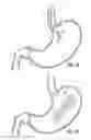 Fig. 06 - Non-Inflatable Gastric Implants and Systems
