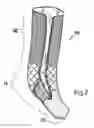 Fig. 03 - Decorative Graduated Compression sock
