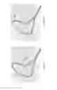 Fig. 61 - Axial lengthening thrombus capture system