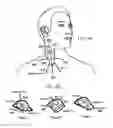 Fig. 08 - Nerve stimulator system