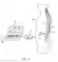 Fig. 04 - Enhanced dorsal horn stimulation using multiple electrical fields
