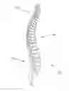 Fig. 01 - Device and method for treatment of spondylotic disease