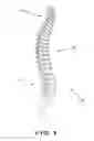Fig. 02 - Device and method for treatment of spondylotic disease
