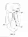 Fig. 45 - Coaptation enhancement implant, system, and method