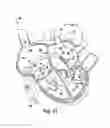 Fig. 12 - Implantable cardiovascular valve
