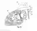 Fig. 20 - Implantable cardiovascular valve