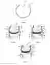 Fig. 05 - Resilient knee implant and methods