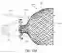 Fig. 85 - Intragastric device for treating obesity