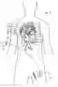 Fig. 02 - Pacing guidewire