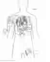 Fig. 02 - Pacing guidewire