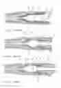Fig. 02 - Eductor suitable for use in an assembly for preparing a liquid product, an assembly for preparing a liquid product and a system for preparing a liquid product