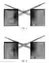Fig. 08 - SYSTEMS AND METHODS FOR MEASURING AND ASSESSING SPINE INSTABILITY