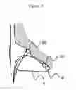 Fig. 04 - Apparatus for recording and analysing a surface electrocardiogram (ECG) for distinguishing a physiological signal from noise
