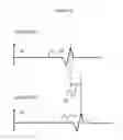 Fig. 11 - Apparatus for recording and analysing a surface electrocardiogram (ECG) for distinguishing a physiological signal from noise