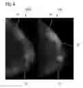 Fig. 05 - Method and image data system for generating a combined contrast medium and blood vessel representation of breast tissue to be examined, computer program product and computer-readable medium