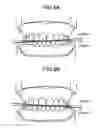 Fig. 08 - X-ray CT apparatus including processing circuitry to perform a metal-artifact reducing process