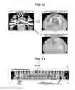Fig. 12 - X-ray CT apparatus including processing circuitry to perform a metal-artifact reducing process