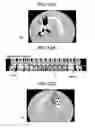 Fig. 13 - X-ray CT apparatus including processing circuitry to perform a metal-artifact reducing process