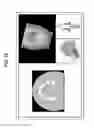 Fig. 20 - X-ray CT apparatus including processing circuitry to perform a metal-artifact reducing process