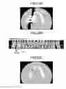 Fig. 23 - X-ray CT apparatus including processing circuitry to perform a metal-artifact reducing process