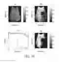 Fig. 11 - Device and method for automatic pneumothorax detection