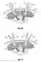 Fig. 19 - Minimally open interbody access retraction device and surgical method