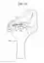 Fig. 23 - TISSUE AUGMENTATION TACKS FOR USE WITH SOFT TISSUE FIXATION REPAIR SYSTEMS AND METHODS