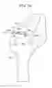 Fig. 24 - TISSUE AUGMENTATION TACKS FOR USE WITH SOFT TISSUE FIXATION REPAIR SYSTEMS AND METHODS