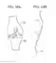 Fig. 30 - TISSUE AUGMENTATION TACKS FOR USE WITH SOFT TISSUE FIXATION REPAIR SYSTEMS AND METHODS