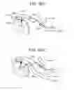 Fig. 84 - TISSUE AUGMENTATION TACKS FOR USE WITH SOFT TISSUE FIXATION REPAIR SYSTEMS AND METHODS