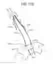 Fig. 91 - TISSUE AUGMENTATION TACKS FOR USE WITH SOFT TISSUE FIXATION REPAIR SYSTEMS AND METHODS