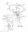 Fig. 16 - Off-center tissue anchors