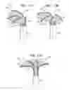 Fig. 24 - Off-center tissue anchors