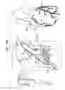 Fig. 26 - Off-center tissue anchors