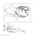 Fig. 27 - Off-center tissue anchors