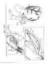 Fig. 29 - Off-center tissue anchors