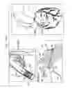Fig. 33 - Off-center tissue anchors
