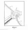 Fig. 05 - Adjustable suture restriction system and method