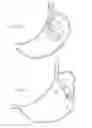 Fig. 12 - Apparatus and method for resectioning gastro-esophageal tissue