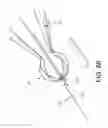 Fig. 47 - METHOD AND APPARATUS FOR RESTRICTING FLOW THROUGH AN OPENING IN THE SIDE WALL OF A BODY LUMEN, AND/OR FOR REINFORCING A WEAKNESS IN THE SIDE WALL OF A BODY LUMEN, WHILE STILL MAINTAINING SUBSTANTIALLY NORMAL FLOW THROUGH THE BODY LUMEN