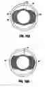 Fig. 06 - Atherectomy device