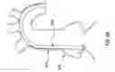 Fig. 45 - Prosthetic Valve System and Methods for Transluminal Delivery