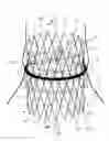 Fig. 01 - Expandable annulus sealing ring for stented minimally invasive heart valve prostheses