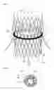 Fig. 02 - Expandable annulus sealing ring for stented minimally invasive heart valve prostheses