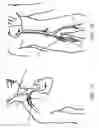Fig. 06 - Devices and methods for controlling blood perfusion pressure along with regional mild hypothermia