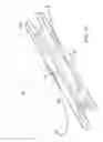 Fig. 02 - Infusion set improvements