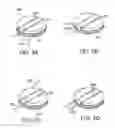 Fig. 04 - Infusion set improvements